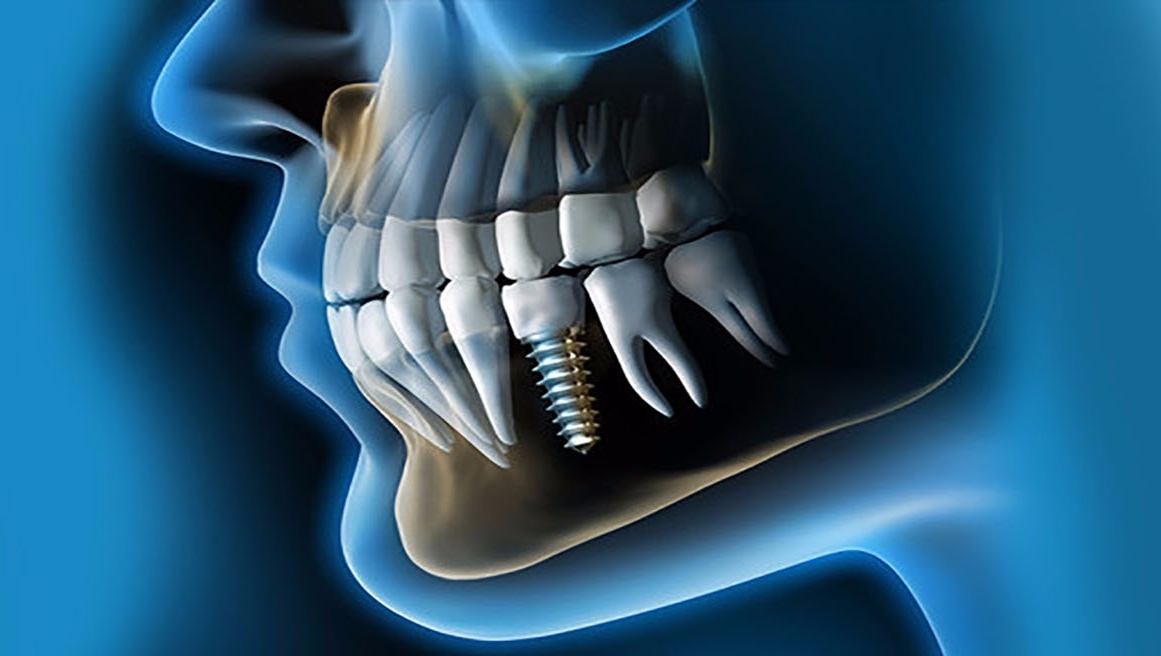 Implantes-dentales-Valencia